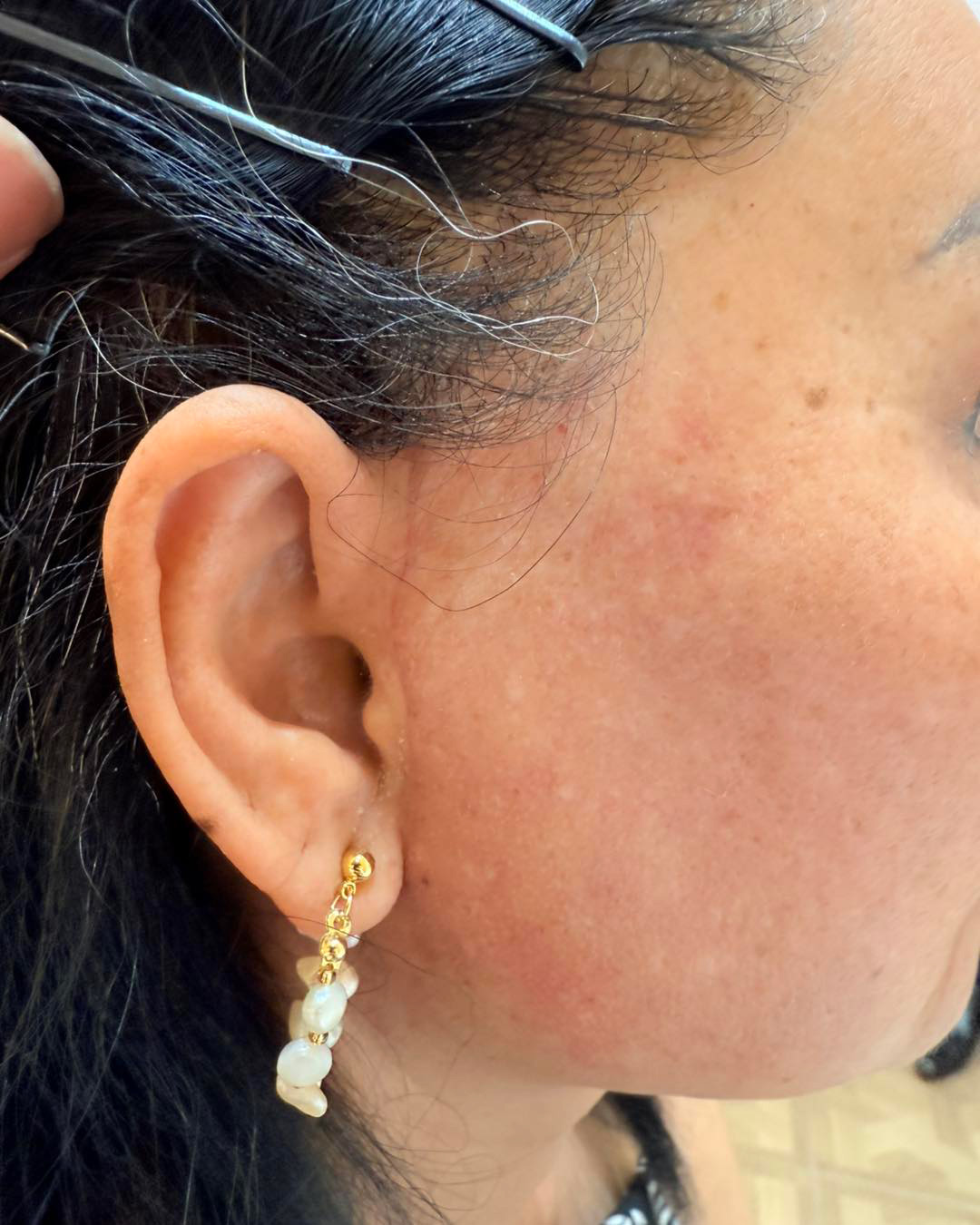 surgical markings and scars