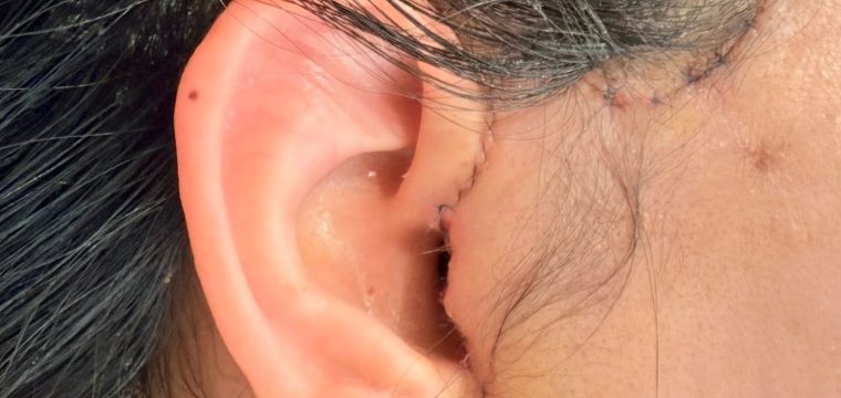 facelift incision types